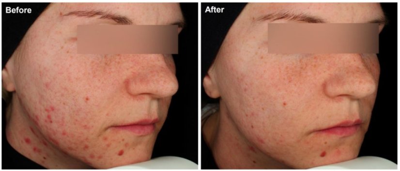  ANNA BRANDEJS Clear Skin Cream 50 ml