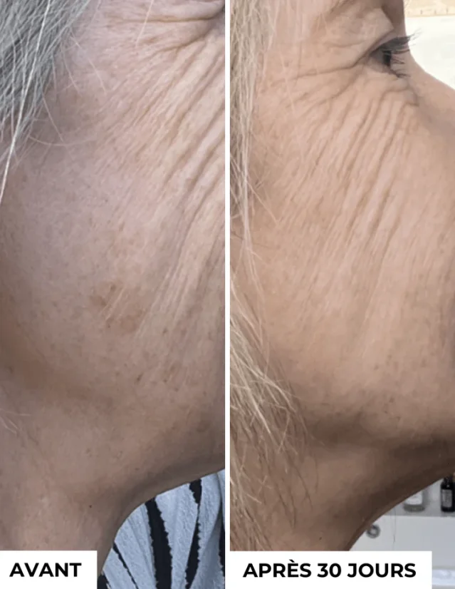 DERMEDEN Anti-Dark Spots - koncentrát proti pigmentaci 3 x 10 ml