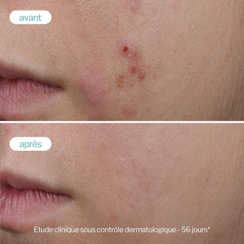 NOVEXPERT Trio-Zinc Serum - pro mastnou a aknózní pleť