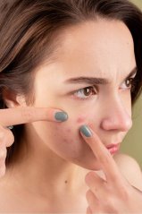 BIRETIX Tri-Active Gel - gel na problematickou pleť s akné 50 ml